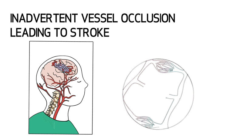 AVM Resection